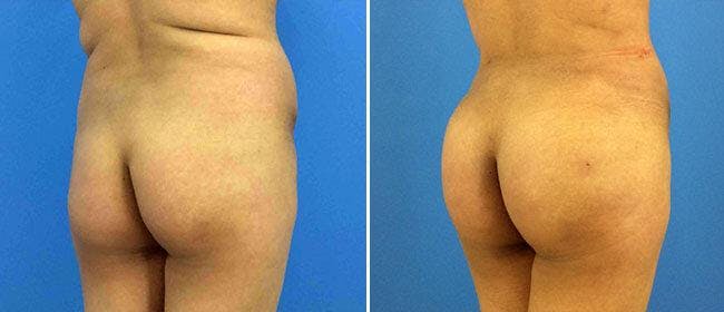 Brazilian Butt Lift Before & After Gallery - Patient 38566474 - Image 1