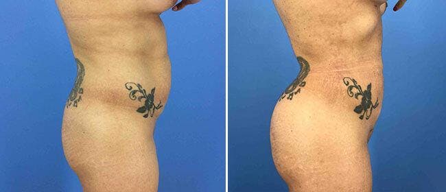 Buttocks Enlargement (Implants) Before & After Gallery - Patient 38566475 - Image 1
