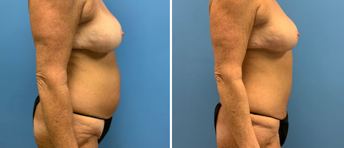 Tummy Tuck Before & After Gallery - Patient 38566479 - Image 2