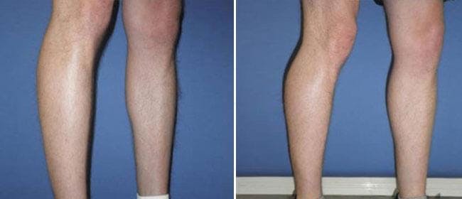 Calf Implants Before & After Gallery - Patient 38566477 - Image 1