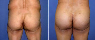 Brazilian Butt Lift Before & After Gallery - Patient 38566478 - Image 1