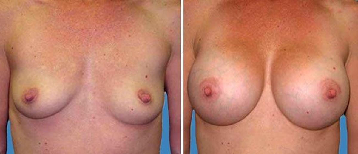 Breast Augmentation Before & After Gallery - Patient 38566480 - Image 1