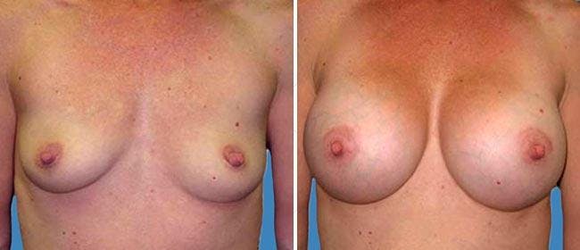 Breast Augmentation Before & After Gallery - Patient 38566480 - Image 1