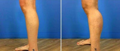 Calf Implants Before & After Gallery - Patient 38566481 - Image 1