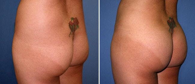 Brazilian Butt Lift Before & After Gallery - Patient 38566482 - Image 1