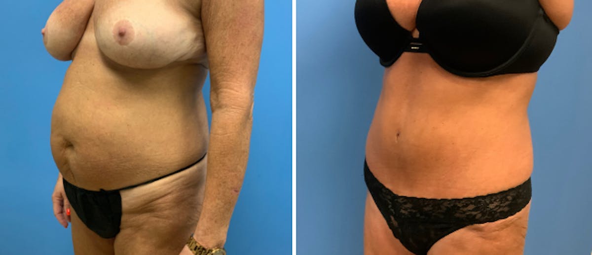 Tummy Tuck Before & After Gallery - Patient 38566479 - Image 3