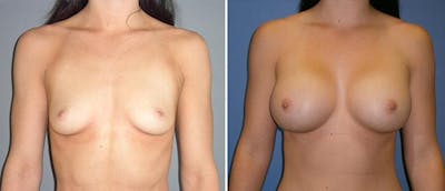 Breast Augmentation Before & After Gallery - Patient 38566483 - Image 1