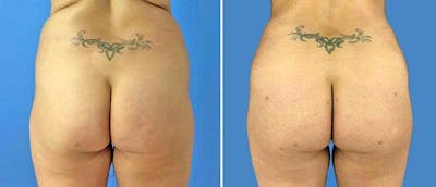 Butt Augmentation Before & After Gallery - Patient 38566486 - Image 1