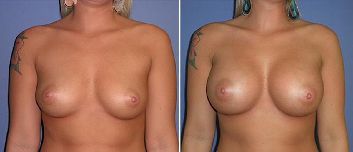 Breast Augmentation Before & After Gallery - Patient 38566488 - Image 1