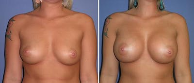Breast Augmentation Before & After Gallery - Patient 38566488 - Image 1