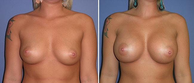 Breast Augmentation Before & After Gallery - Patient 38566488 - Image 1