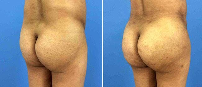 Brazilian Butt Lift Before & After Gallery - Patient 38566490 - Image 1