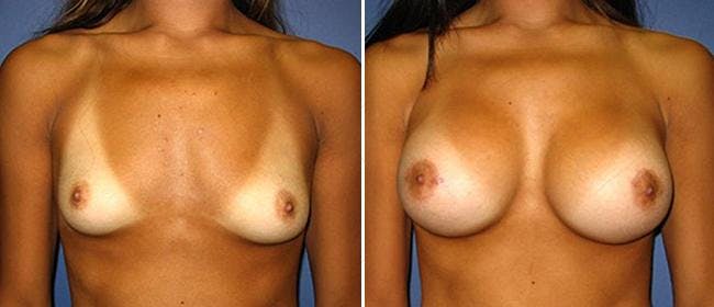 Breast Augmentation Before & After Gallery - Patient 38566492 - Image 1