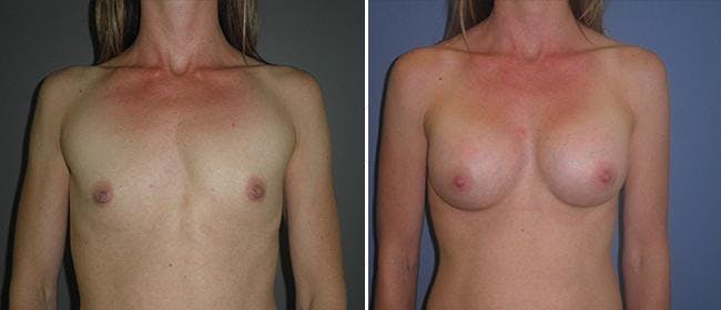 Breast Augmentation Before & After Gallery - Patient 38566494 - Image 1