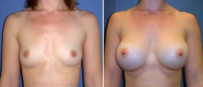Breast Augmentation Before & After Gallery - Patient 38566498 - Image 1