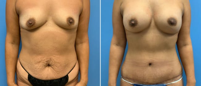 Abdominoplasty (Tummy Tuck) Before & After Gallery - Patient 38566500 - Image 1