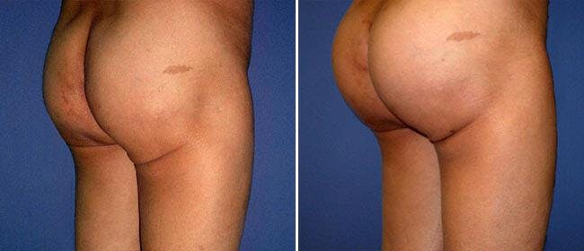 Brazilian Butt Lift Before & After Gallery - Patient 38566499 - Image 1