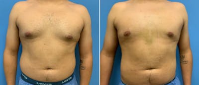 Gynecomastia Before & After Gallery - Patient 38566503 - Image 1