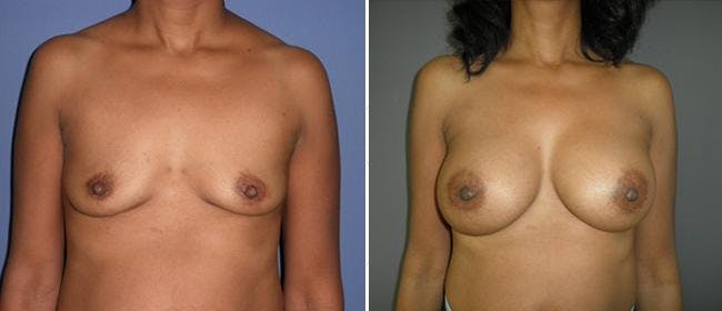 Breast Augmentation Before & After Gallery - Patient 38566502 - Image 1