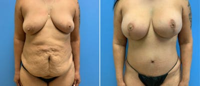 Abdominoplasty (Tummy Tuck) Before & After Gallery - Patient 38566504 - Image 1