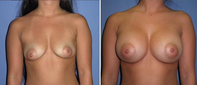Breast Augmentation Before & After Gallery - Patient 38566505 - Image 1