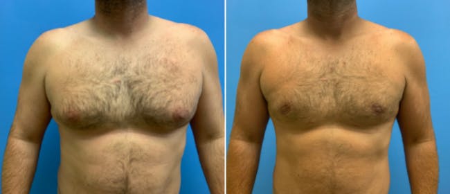 Gynecomastia Before & After Gallery - Patient 38566513 - Image 1