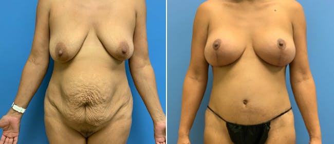 Abdominoplasty (Tummy Tuck) Before & After Gallery - Patient 38566515 - Image 1