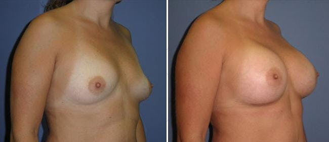 Breast Augmentation Before & After Gallery - Patient 38566514 - Image 1
