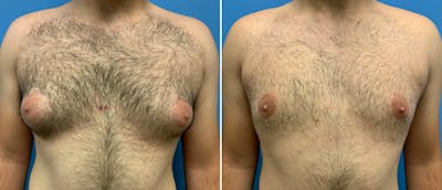 Liposuction / Bodytite Before & After Gallery - Patient 38566511 - Image 1
