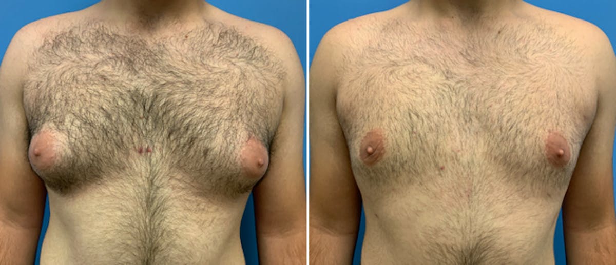 Liposuction Before & After Gallery - Patient 38566511 - Image 1