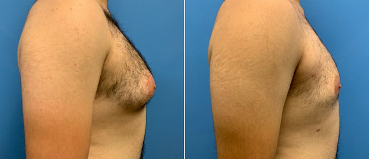 Liposuction Before & After Gallery - Patient 38566511 - Image 2