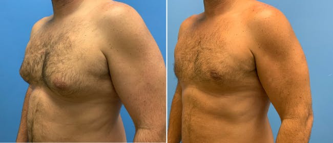 Gynecomastia Before & After Gallery - Patient 38566513 - Image 2