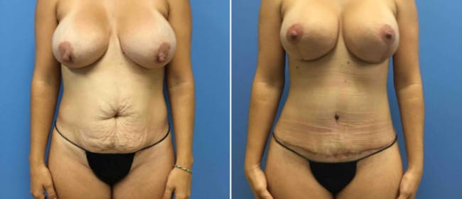 Abdominoplasty (Tummy Tuck) Before & After Gallery - Patient 38566522 - Image 1