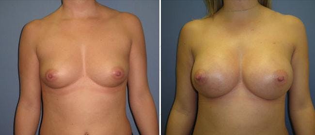 Breast Augmentation Before & After Gallery - Patient 38566525 - Image 1