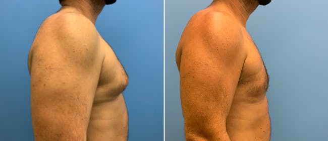 Gynecomastia Before & After Gallery - Patient 38566513 - Image 3