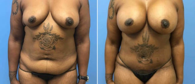 Abdominoplasty (Tummy Tuck) Before & After Gallery - Patient 38566527 - Image 1