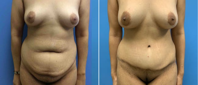 Abdominoplasty (Tummy Tuck) Before & After Gallery - Patient 38566533 - Image 1