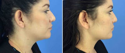 Liposuction Before & After Gallery - Patient 38566531 - Image 1