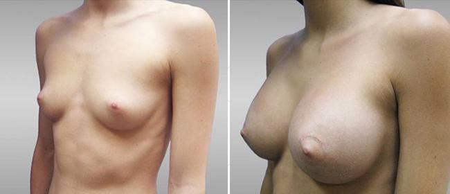 Breast Augmentation Before & After Gallery - Patient 38566532 - Image 1