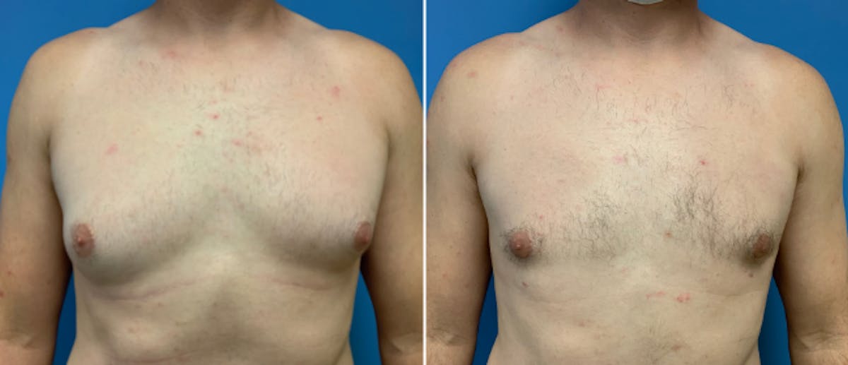 Gynecomastia Before & After Gallery - Patient 38566535 - Image 1