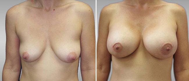 Breast Augmentation Before & After Gallery - Patient 38566536 - Image 1
