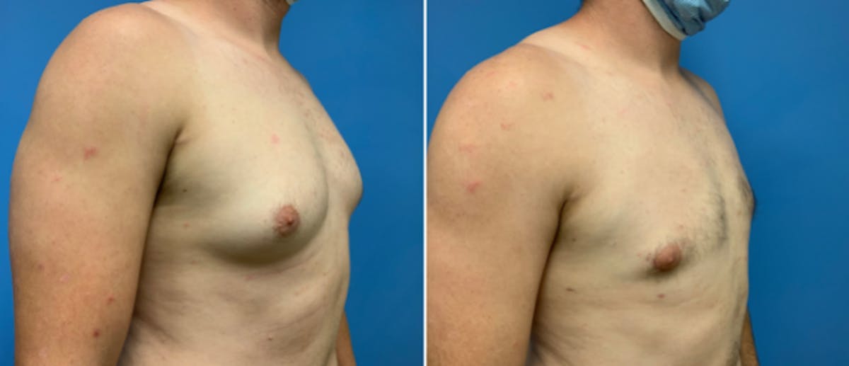 Gynecomastia Before & After Gallery - Patient 38566535 - Image 2