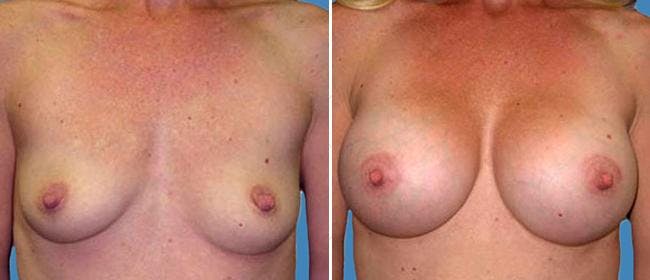 Breast Augmentation Before & After Gallery - Patient 38566540 - Image 1