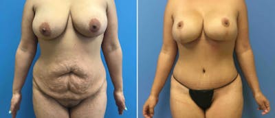 Abdominoplasty (Tummy Tuck) Before & After Gallery - Patient 38566541 - Image 1