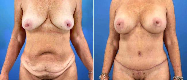 Abdominoplasty (Tummy Tuck) Before & After Gallery - Patient 38566546 - Image 1