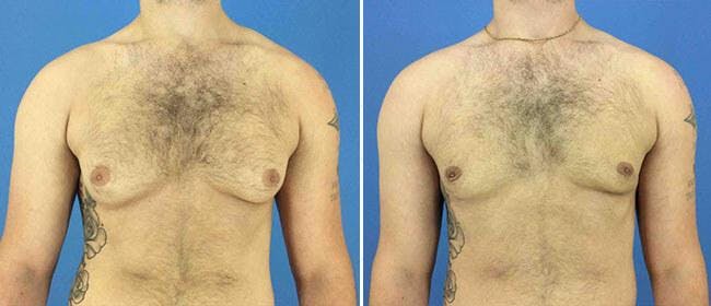 Gynecomastia Before & After Gallery - Patient 38566545 - Image 1