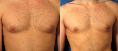 Gynecomastia Before & After Gallery - Patient 38566550 - Image 1