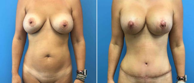 Abdominoplasty (Tummy Tuck) Before & After Gallery - Patient 38566551 - Image 1