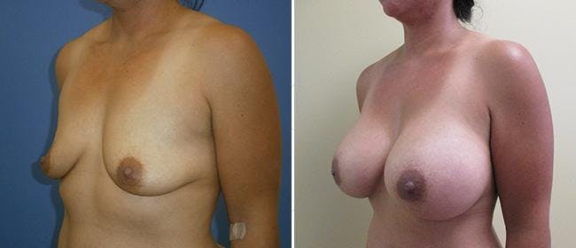 Breast Augmentation Before & After Gallery - Patient 38566552 - Image 1