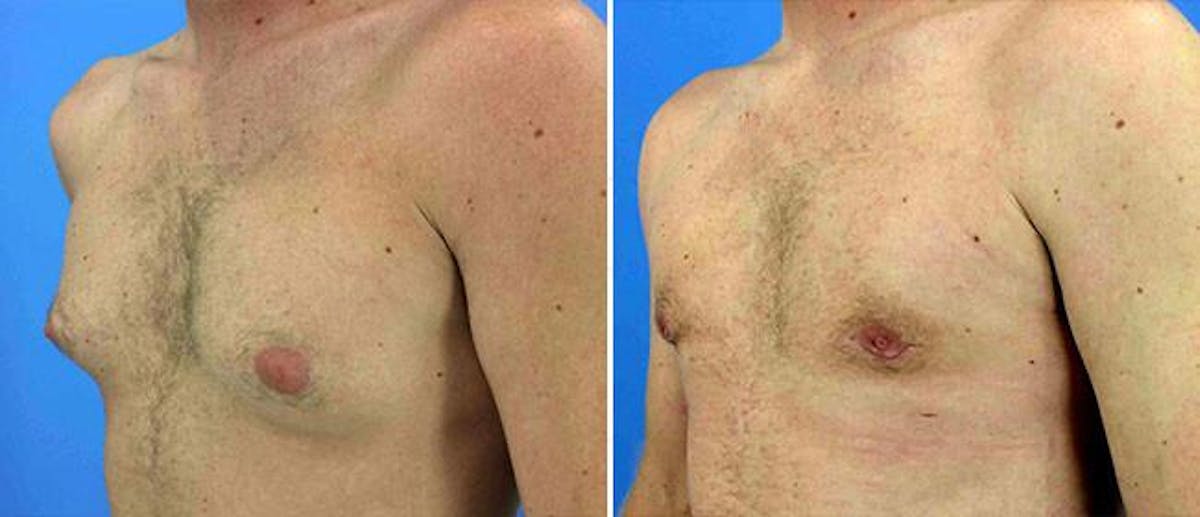 Gynecomastia Before & After Gallery - Patient 38566554 - Image 1